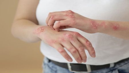 تحذير من مرض الحزام الناري وأهمية العلاج المبكر| تفاصيل