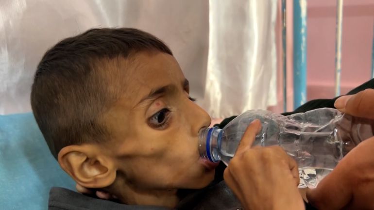 حياة الأطفال في غزة مهددة بالموت بسبب ارتفاع معدلات سوء التغذية