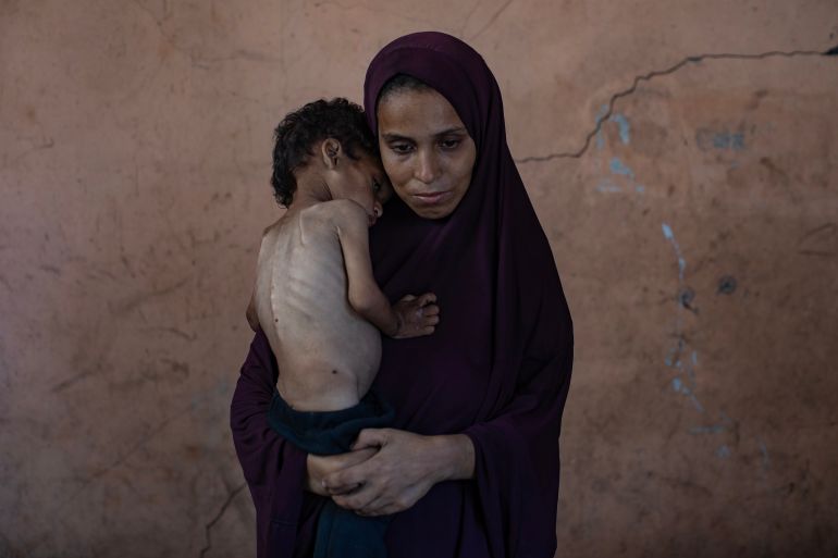 epa12247633 Palestinian child Yazan Abu Foul, aged two, is cared for by his mother Naima, as he suffers from severe malnutrition due to the acute shortage of food caused by the blockade imposed on the Gaza Strip and the closure of border crossings, in Al-Shati refugee camp, west of Gaza City, 19 July 2025. Yazan lives in harsh environmental and health conditions, with his family lacking the basic necessities of life amid a worsening humanitarian crisis. According to medical sources, the child’s health continues to deteriorate due to the lack of proper nutrition and necessary medical care. Humanitarian organizations have warned of an imminent food catastrophe threatening the lives of thousands of children in the besieged Gaza Strip, this situation coming at a time when Gaza’s residents face severe food insecurity and a sharp decline in health services, amid ongoing restrictions on the entry of humanitarian aid and essential supplies. EPA/HAITHAM IMAD