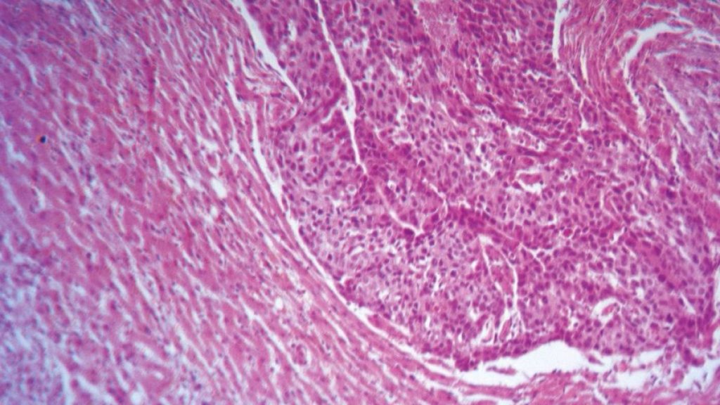 تقنية جديدة لعلاج سرطان الرئة