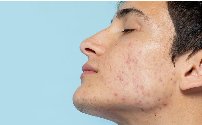 دليلك الشامل لعلاج حب الشباب خطوة بخطوة