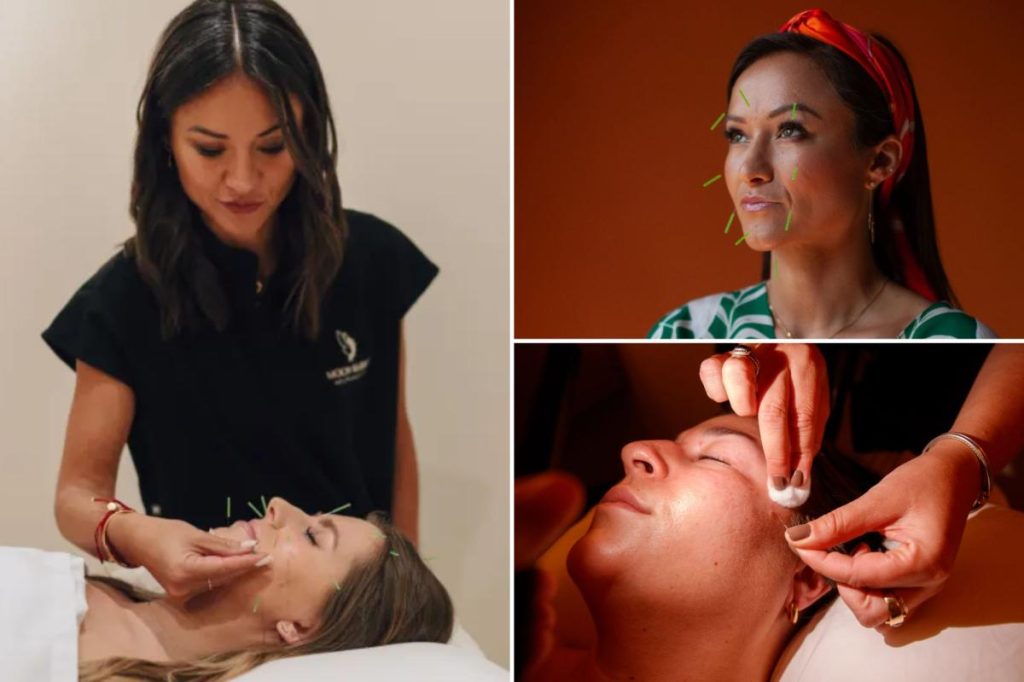 عشاق البوتوكس يلجأون إلى الوخز بالإبر للحصول على بشرة ناعمة وشابة.