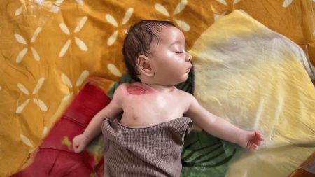 وزارة الصحة الفلسطينية: 6 آلاف ممن بترت أرجلهم أو أحد أطرافهم يحتاجون لبرامج تأهيل عاجلة