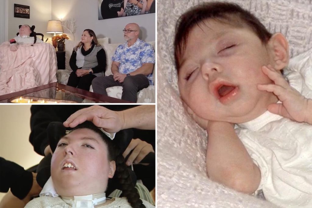 امرأة ولدت بلا دماغ تبلغ العشرين من عمرها في “معجزة طبية”