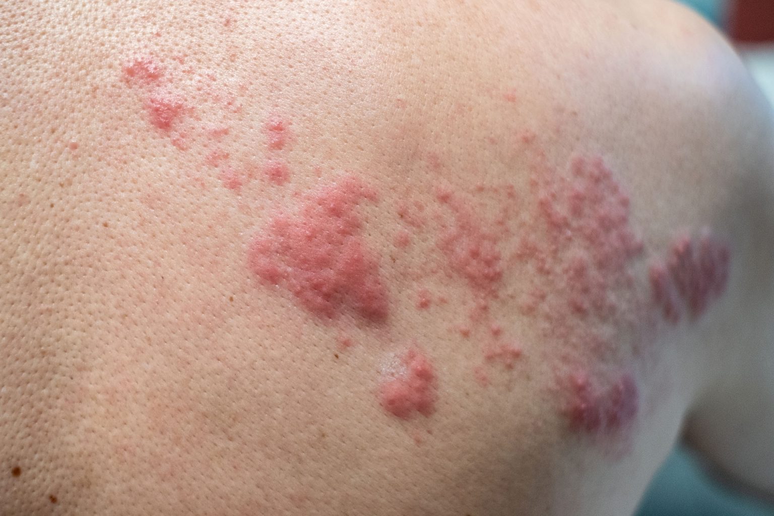 التطعيم ضد الهربس النطاقي مهم لهؤلاء