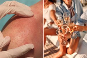 تشهد مناطق ثرية ارتفاعًا في معدلات الإصابة بمرض جلدي قبيح.