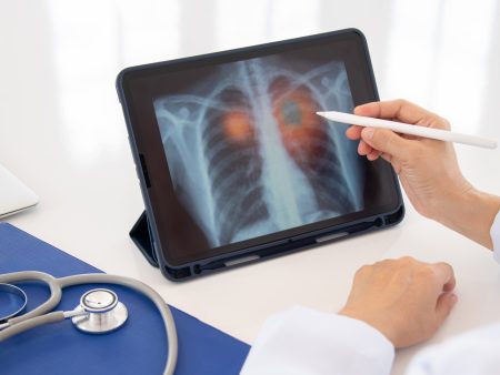 خبراء: سرطان الرئة قابل للعلاج والنجاة