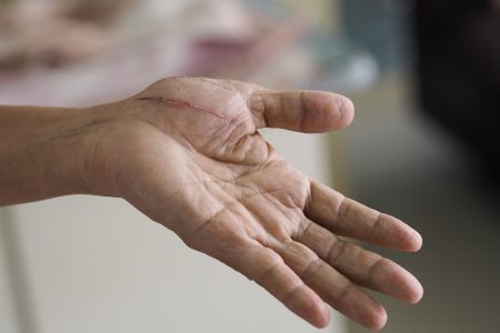 مظهر الندبة يزعجك؟ إليك الحل