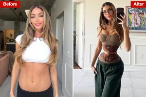 تزداد الإقبال على جراحة إعادة تشكيل الأضلاع مع انتشار اتجاه “جسم أوزمبيك” المحفوف بالمخاطر.