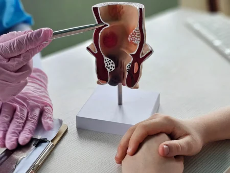 البواسير.. متى يصبح التدخل الجراحي ضرورة؟